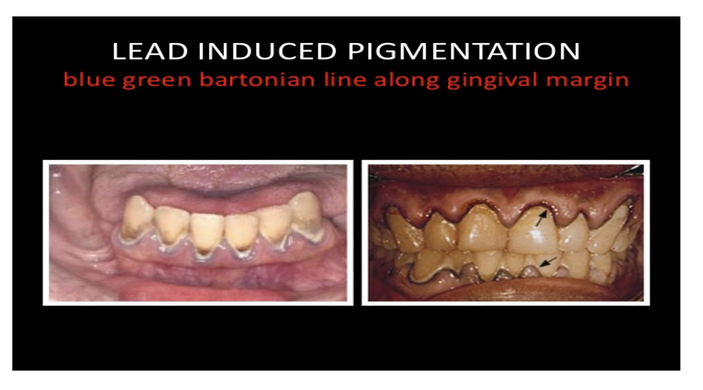 Lead Poisoning - BioPharma Notes