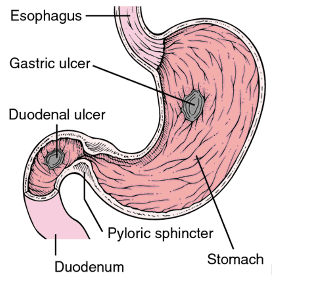 Peptic Ulcer - BioPharma Notes